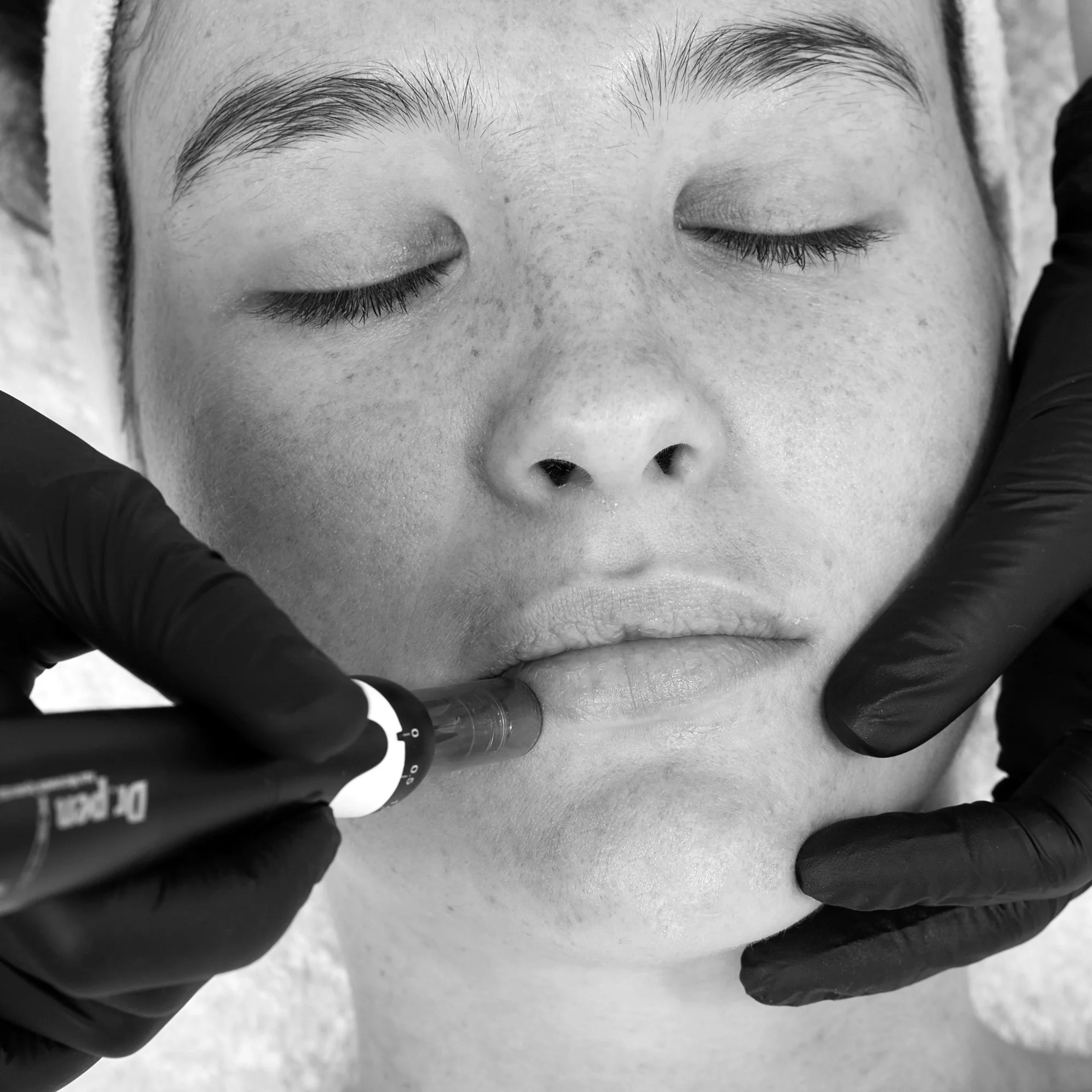 Dermapen microneedling profesional en Cali